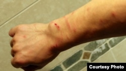 中國著名人權活動家胡佳下週剝奪政治權利期滿前遭到便衣警察毆打 ﹐手部見明顯傷痕。(圖片由胡佳提供)