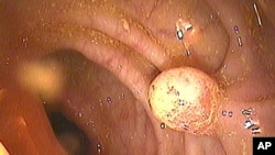 結直腸癌檢驗。