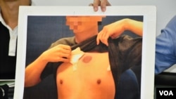 示威者展示傷勢，在6月12日警方清場行動中被警方投擲催淚彈正中胸口上方位置。 (美國之音湯惠芸攝）