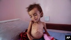 在也門一家醫院中的一個因飢餓而營養不良的兒童。（2018年10月1日）