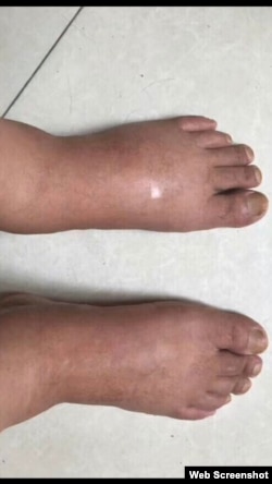 江天勇浮腫的雙腳（網絡截圖）