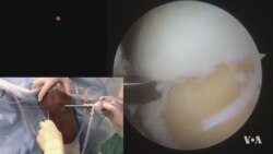 Stem Cells Used to Repair Worn-Out Cartilage